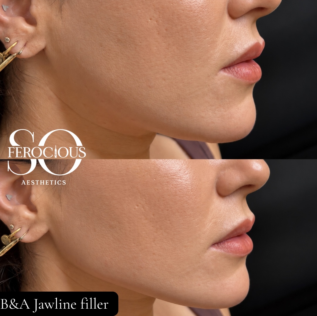 Jawline filler before and after, shown in two profile photographs