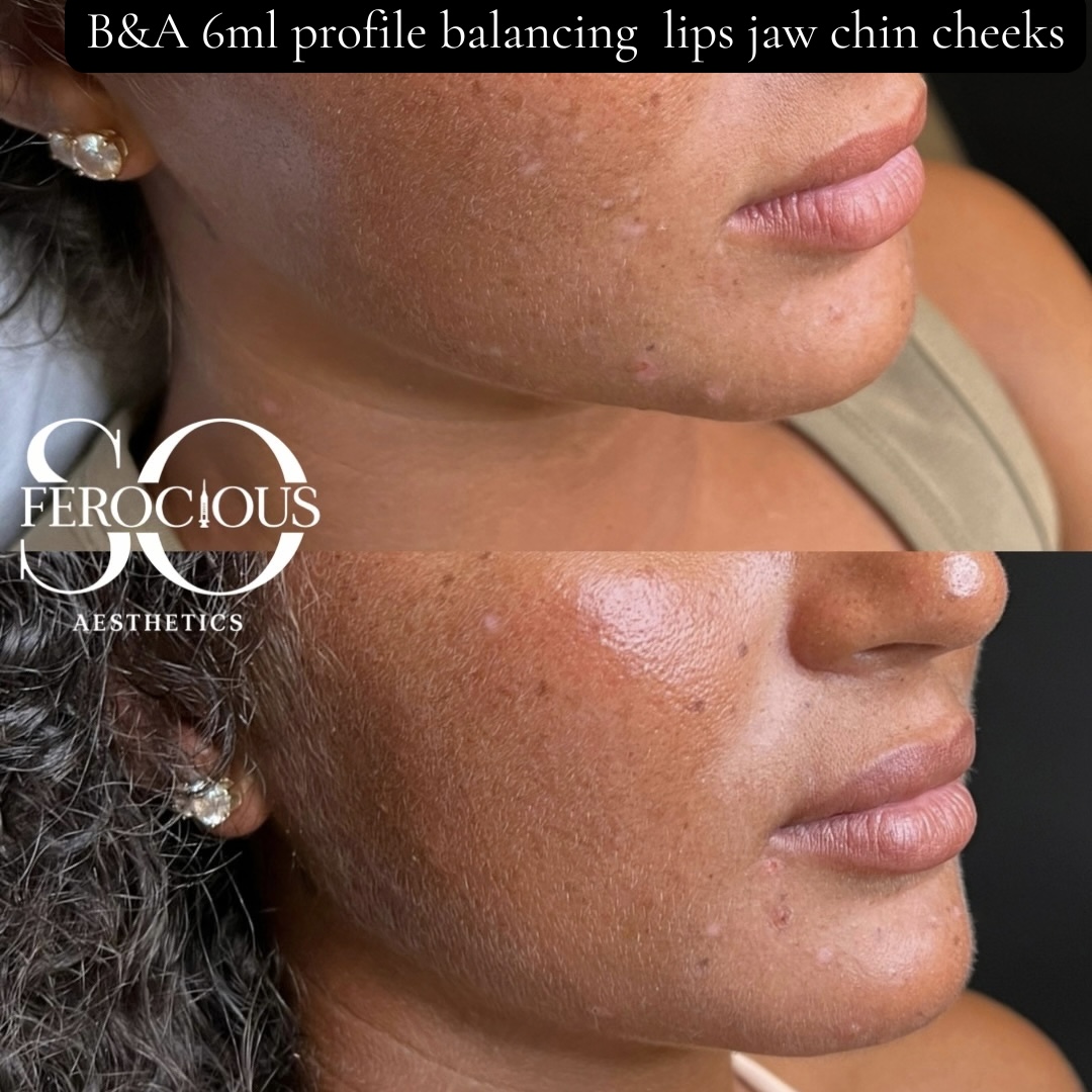 Profile before and after filler to lips, jaw, chin and cheeks