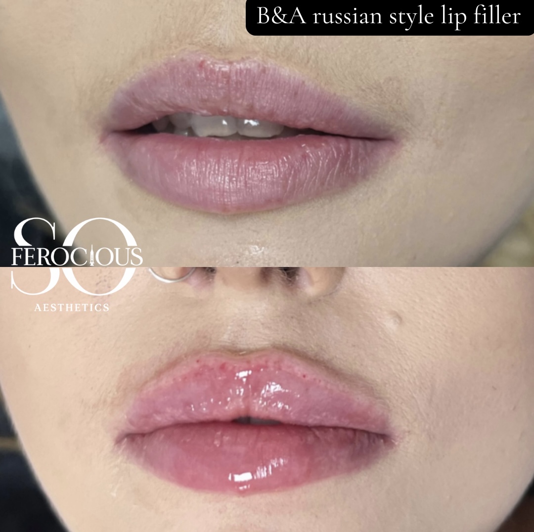 Lips before and after Russian style filler
