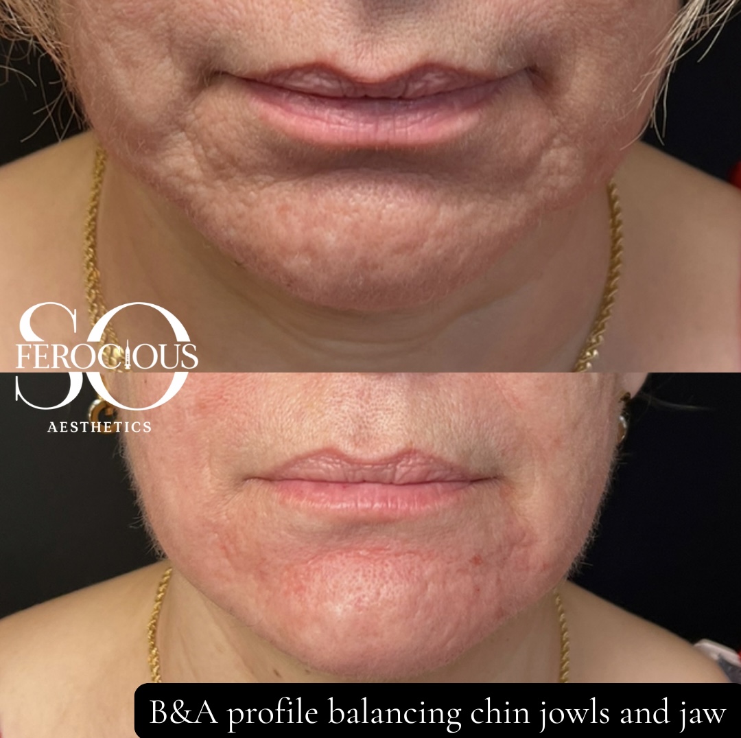 Lower face before and after chin, jowl and jaw treatment
