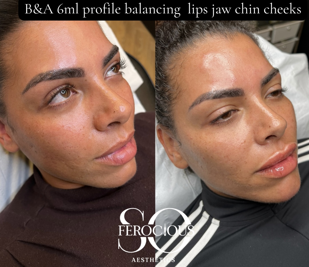 Face before and after filler to lips, jaw, chin and cheeks