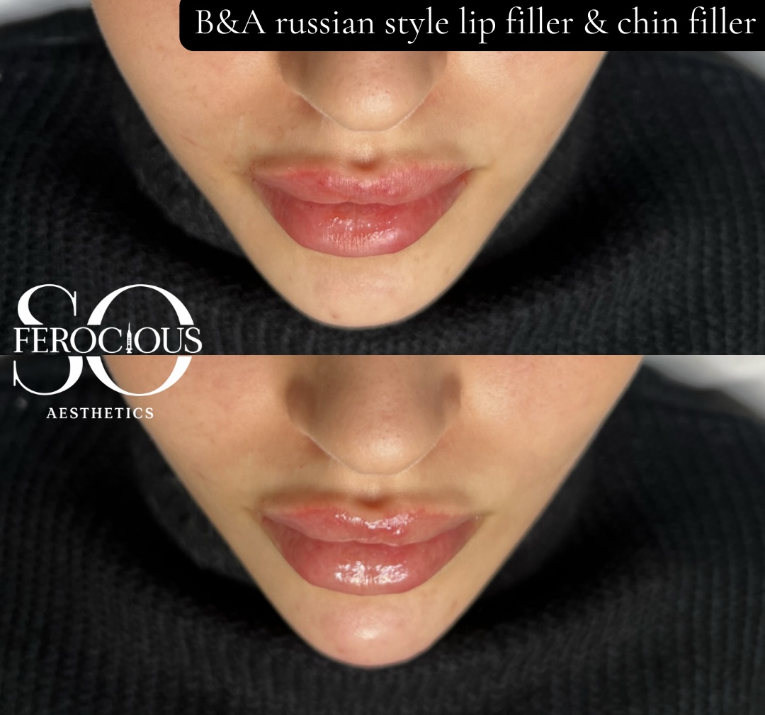 Lips and chin before and after filler