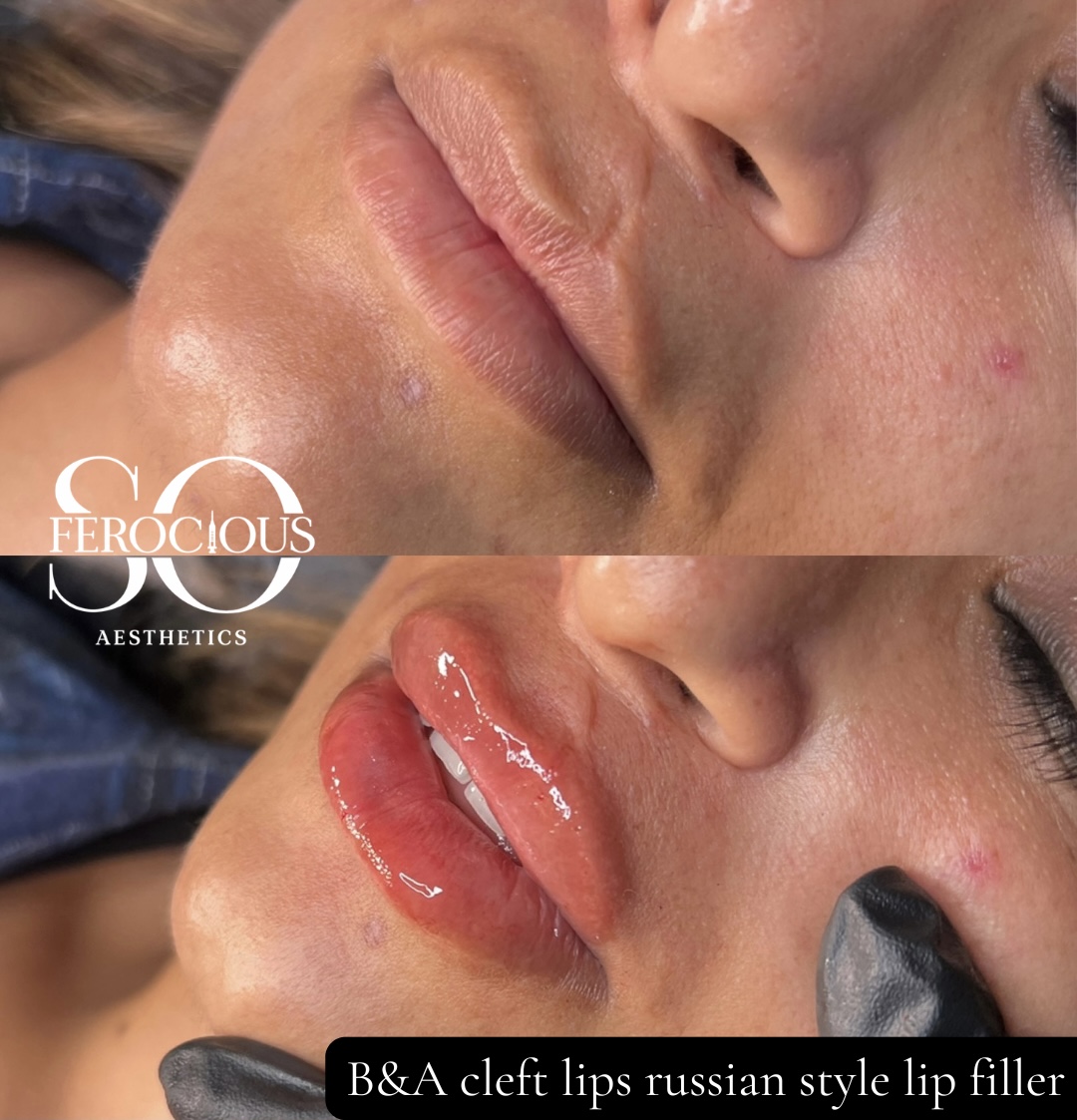 Lips before and after filler, shown in two close-up photographs