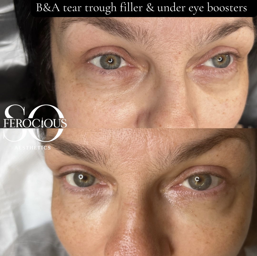 Under-eye area before and after tear trough filler and boosters