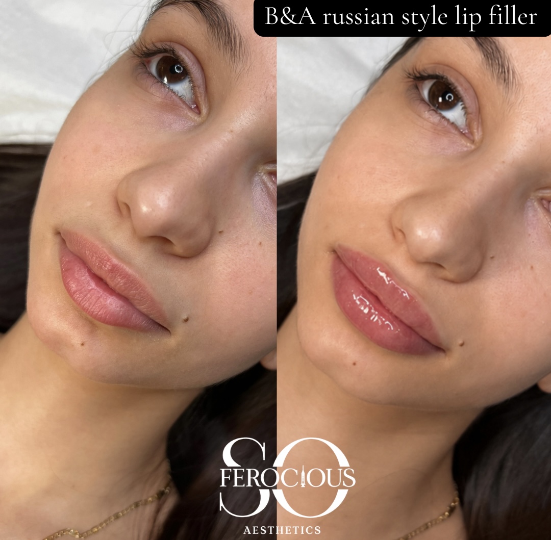 Face before and after Russian style lip filler