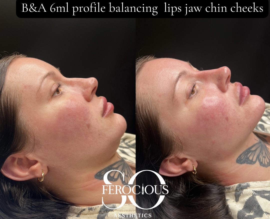 Side profile before and after filler to lips, jaw, chin and cheeks