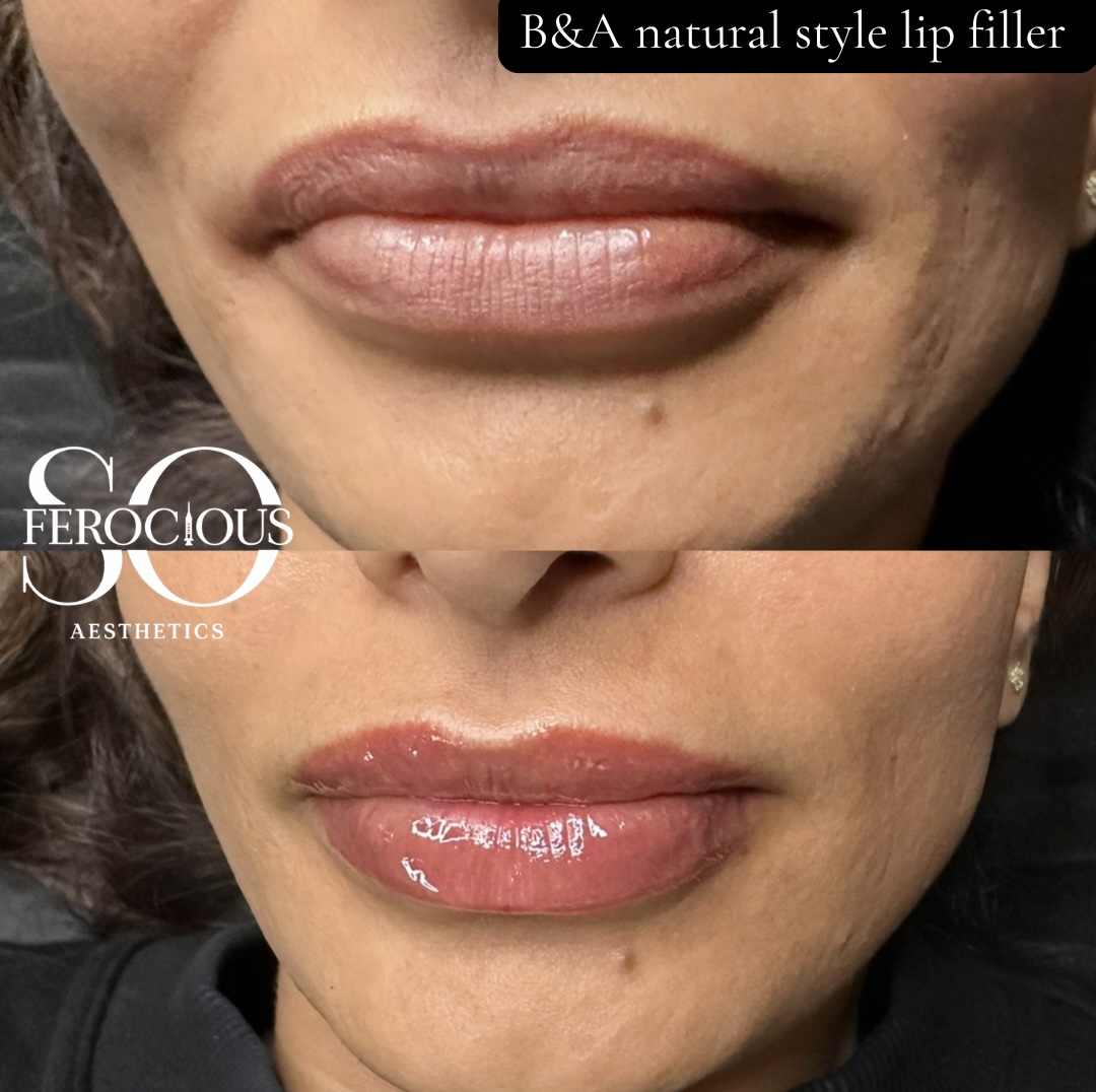 Lips before and after natural style filler