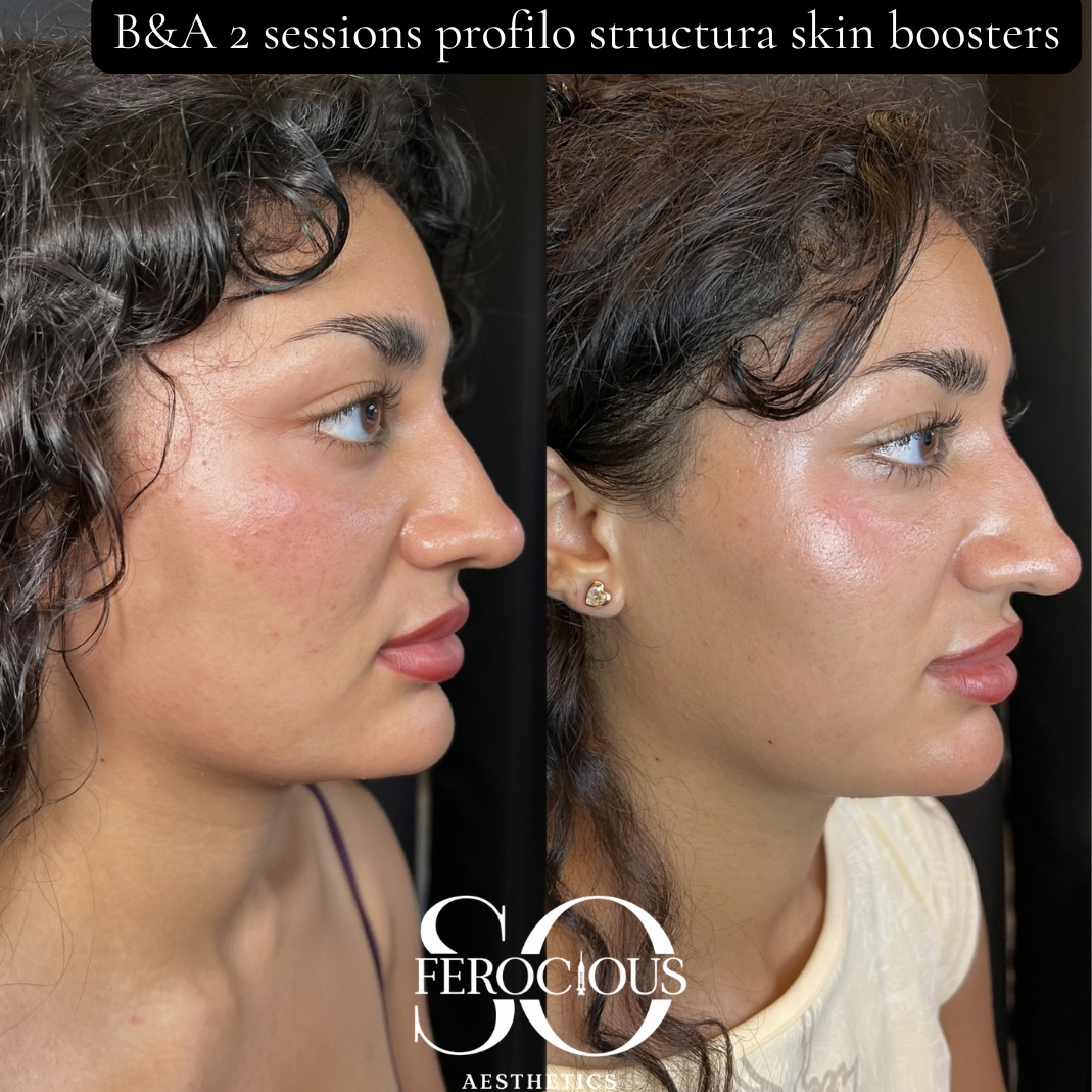 Face before and after two sessions of Profhilo Structura