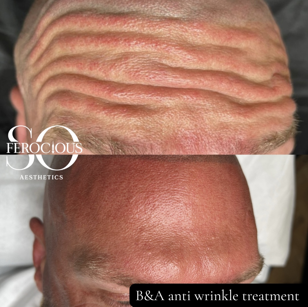 Forehead before and after anti-wrinkle treatment