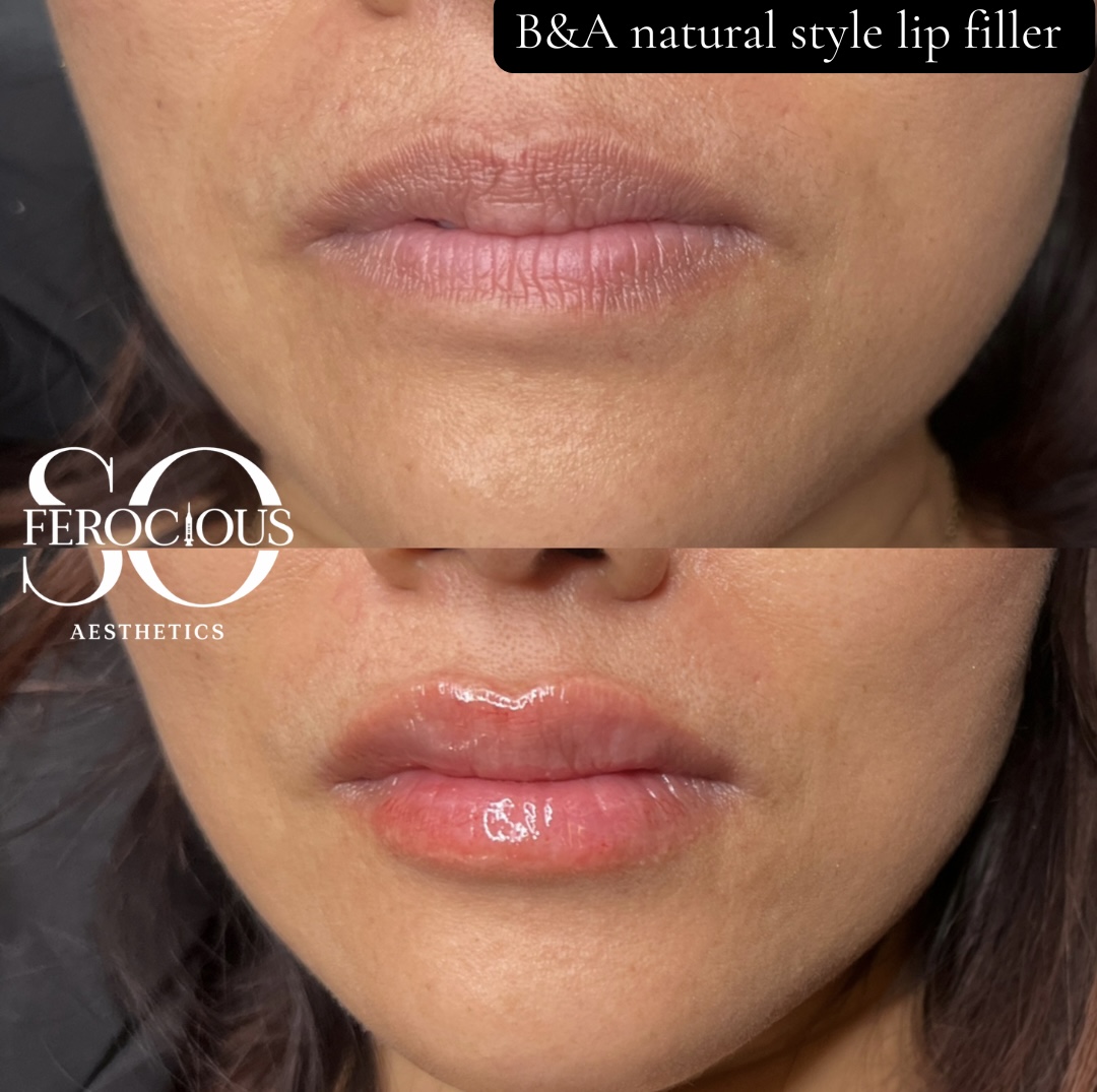 Lips before and after natural style filler
