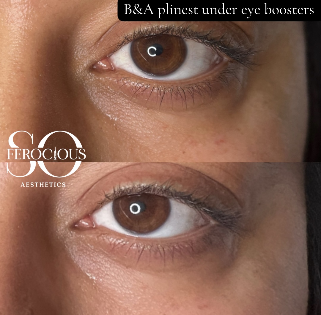 Under-eye area before and after Plinest treatment