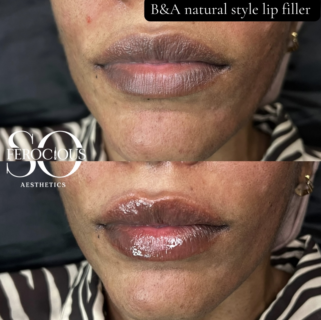 Lips before and after natural style lip filler