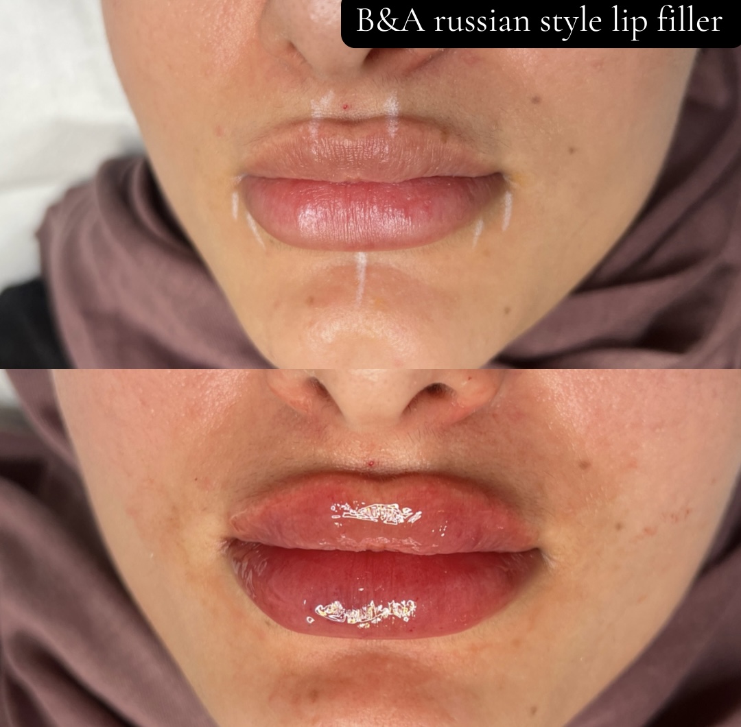 Lips before and after Russian style filler