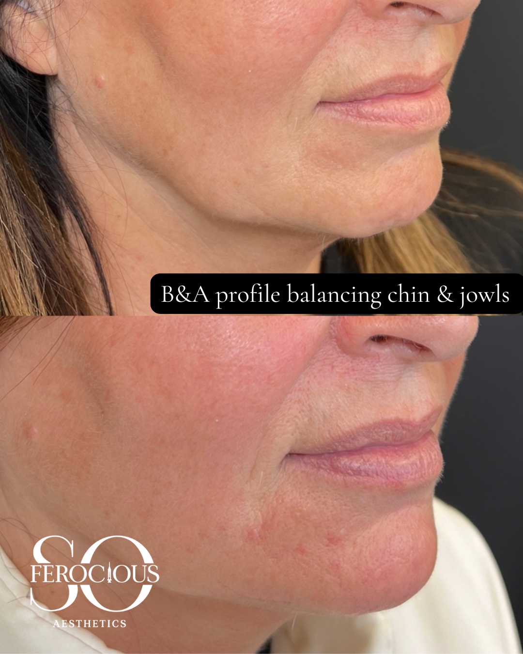 Profile before and after chin and jowl treatment