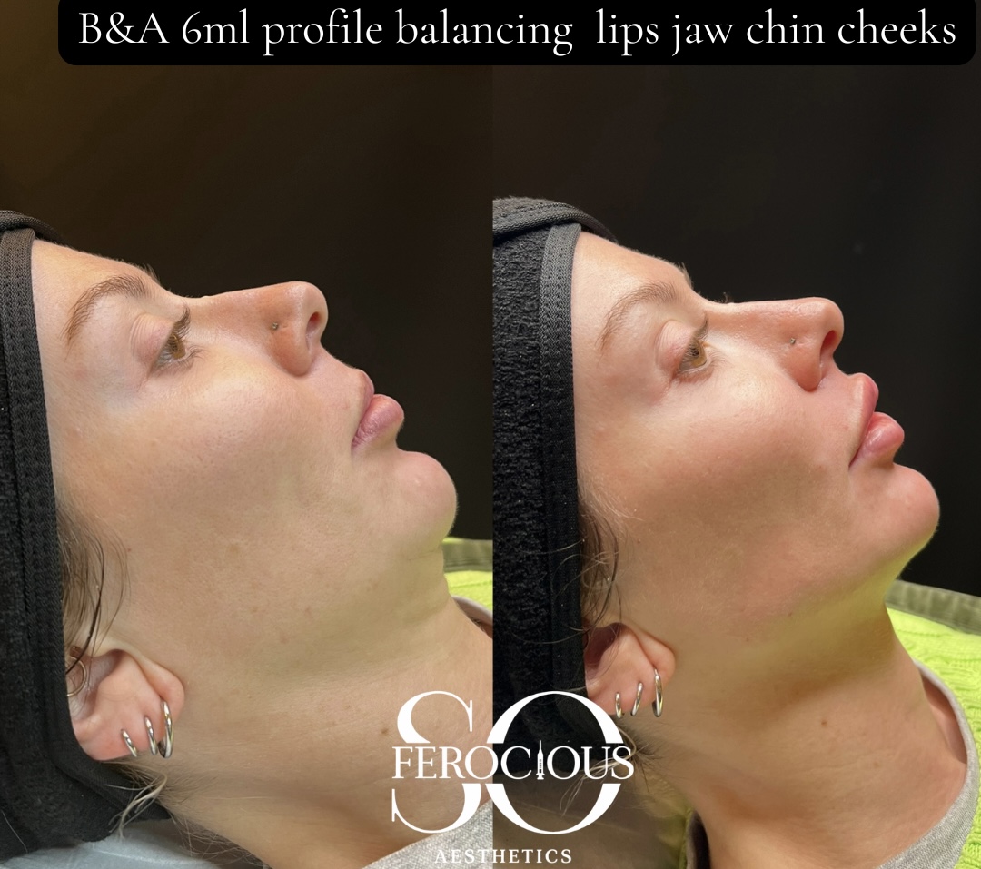 Side profile before and after filler to lips, jaw, chin and cheeks