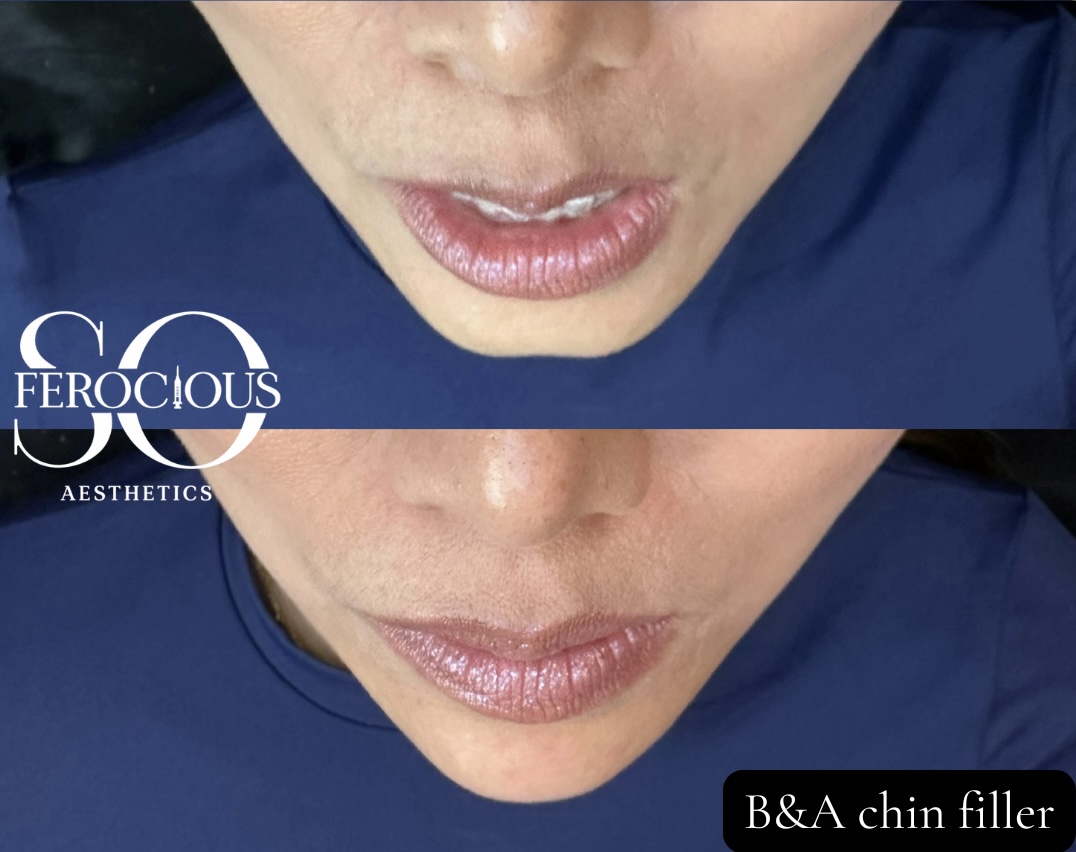 Chin before and after filler