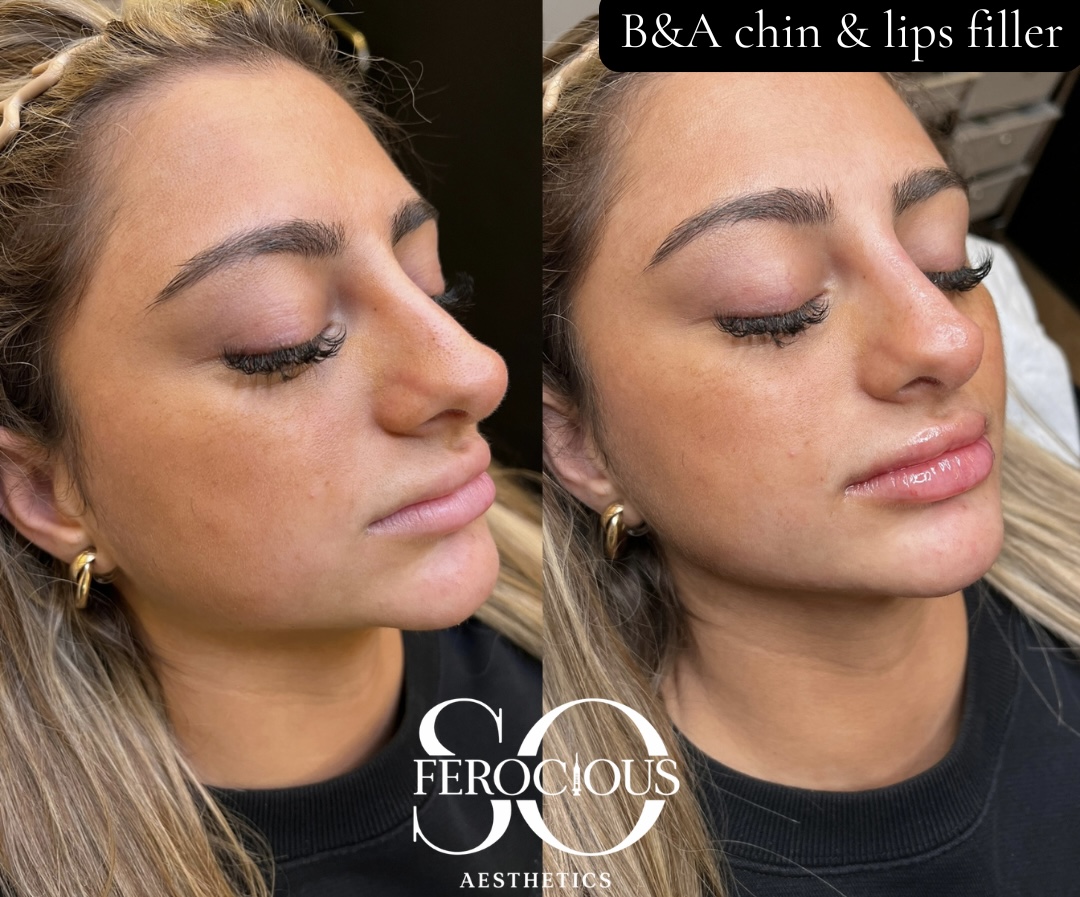 Face before and after chin and lip filler