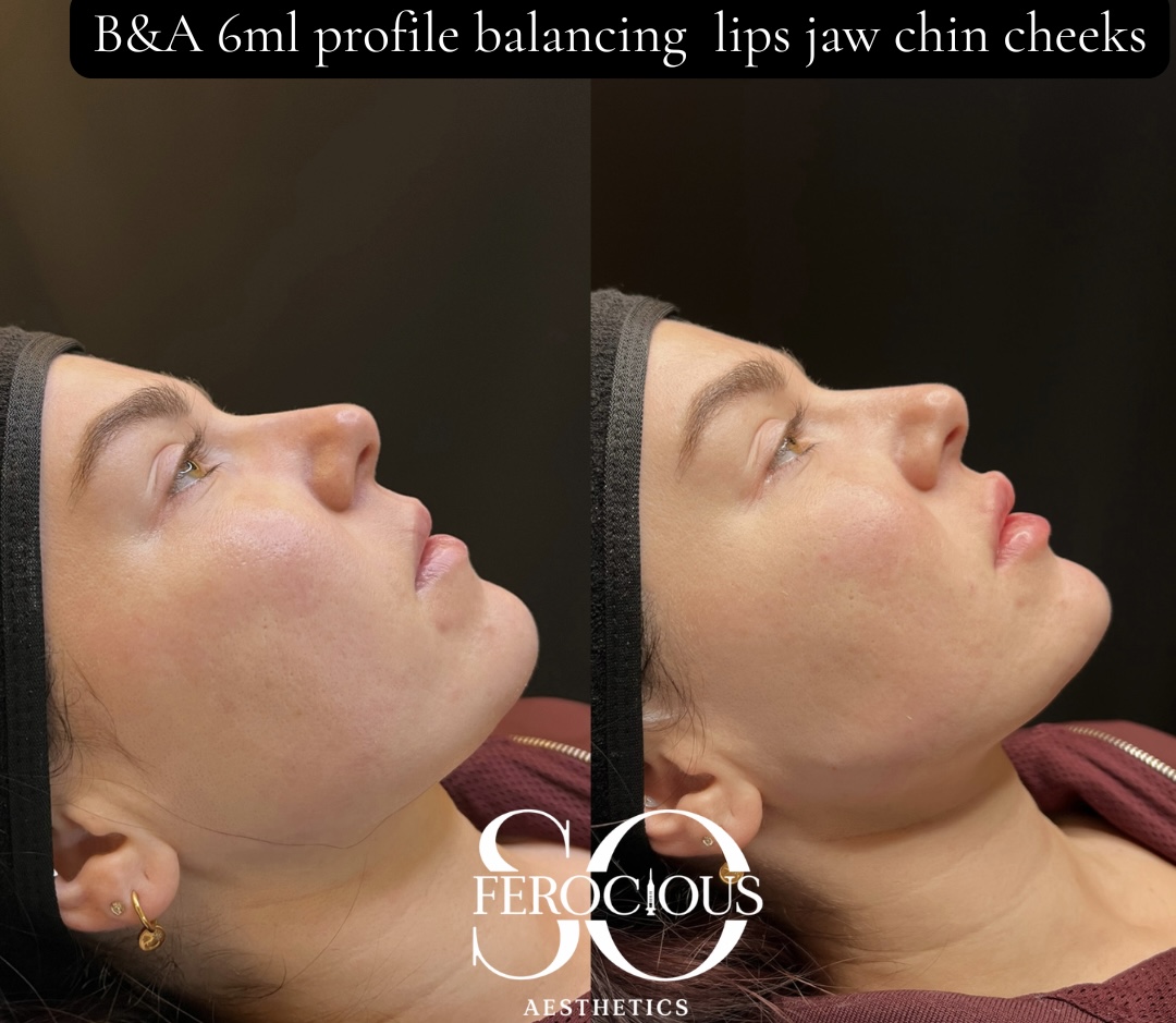 Side profile before and after filler to lips, jaw, chin and cheeks