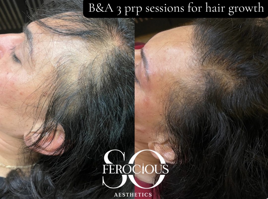 Hairline before and after three PRP treatment sessions