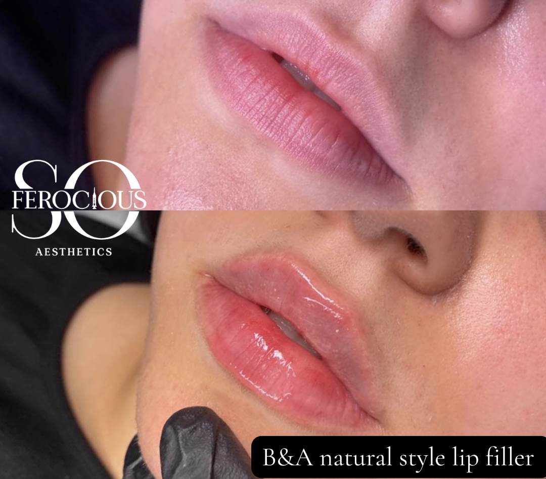 Lips before and after natural style lip filler