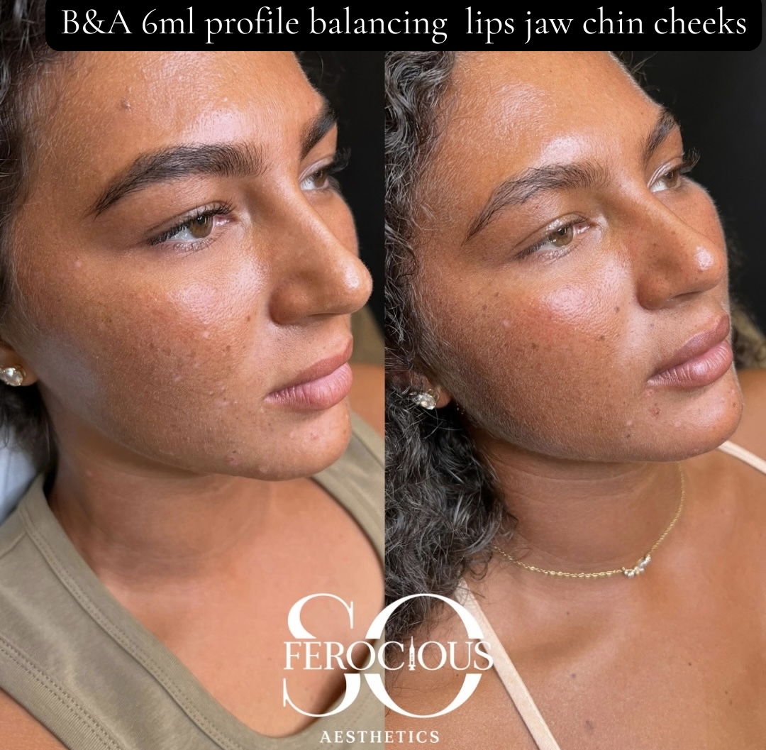 Face before and after filler to lips, jaw, chin and cheeks